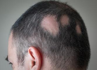 Alopecia Areata: Da Definição À Evolução.