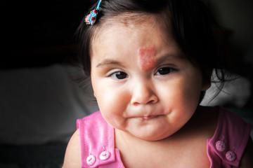 Tratamento Ambulatorial Do Hemangioma Infantil