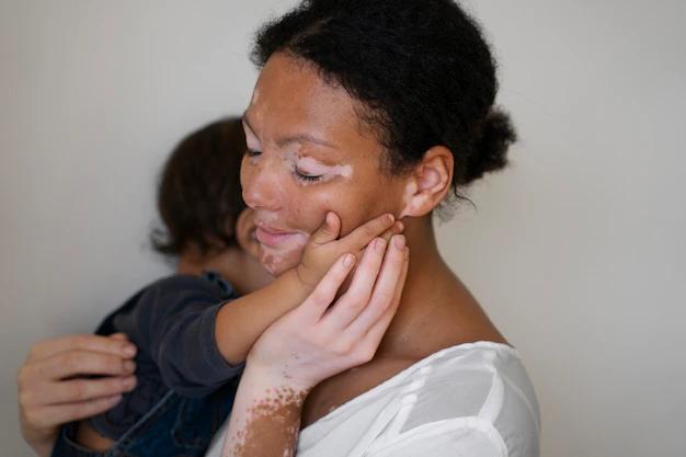 Simplificando O Tratamento Clínico Do Vitiligo