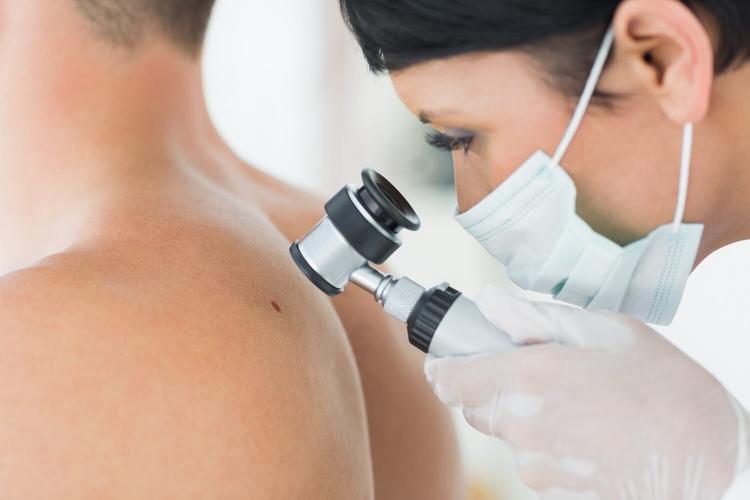 Suspeita De Melanoma: Como Proceder?