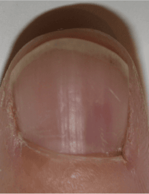 Você Sabe Realizar Tratamento Medicamentoso Para Onicomicose?