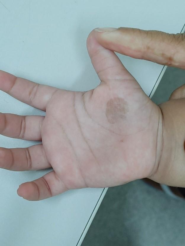 Como Reconhecer A Tinea Nigra?