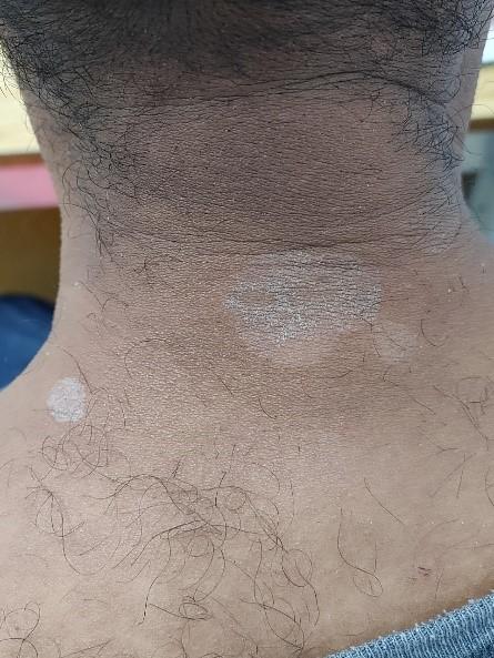 Pitiríase Versicolor X Pitiríase Alba: Como Fazer O Diagnóstico Diferencial?