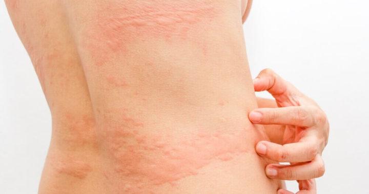 Causas De Urticária Aguda