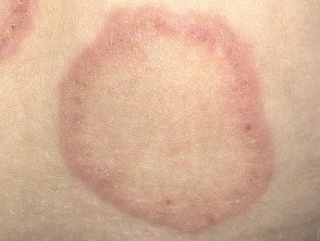 Eritema Anular Centrífugo Superficial X Profundo: Quais As Diferenças?