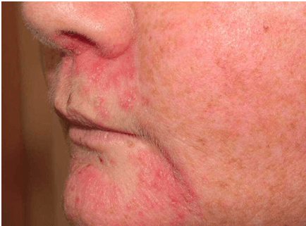 Dermatite Perioral
