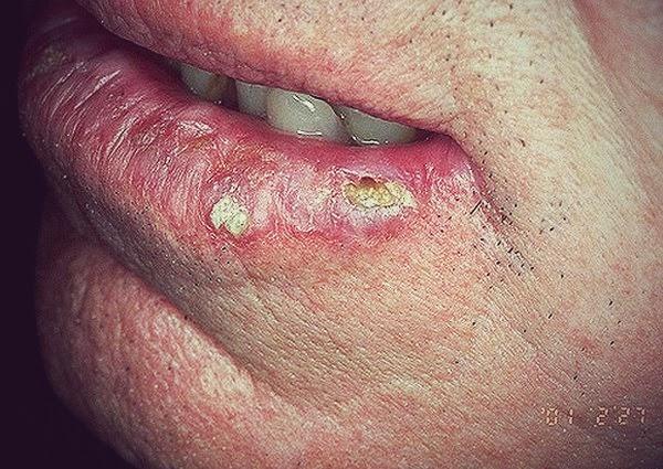 Tratamento Da Queilite Actínica: Pontos De Revisão Sistemática