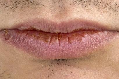 Por Que Precisamos Tratar A Queilite Actínica?