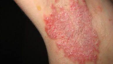 Doença De Hailey- Hailey: Um Diagnóstico Diferencial Importante Para Pacientes Com Lesões Nas Regiões Flexurais