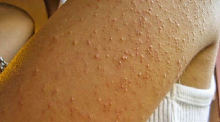 Queratose Pilar – Como Reconhecer E Tratar