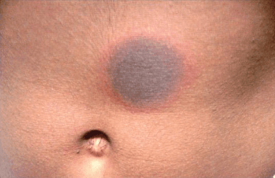 Erupção Fixa Medicamentosa: Você Sabe Reconhecê-la?