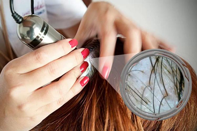 Tricoscopia: O Que As Escamas Podem Ajudar No Diagnóstico De Patologias Do Couro Cabeludo?