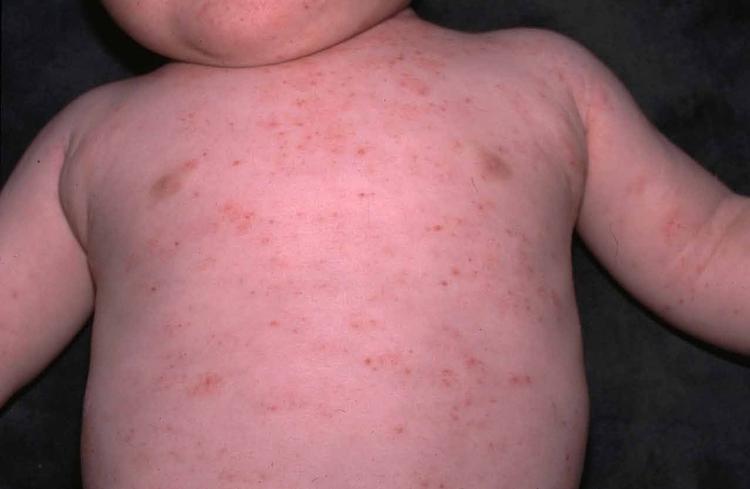 Síndrome De Wiskott-aldrich