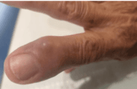 Cisto Mixoide Digital: Pode Ser Uma Consequência À Osteoartrite?