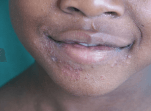 Dermatite Perioral: Dica De Ouro Para O Diagnóstico