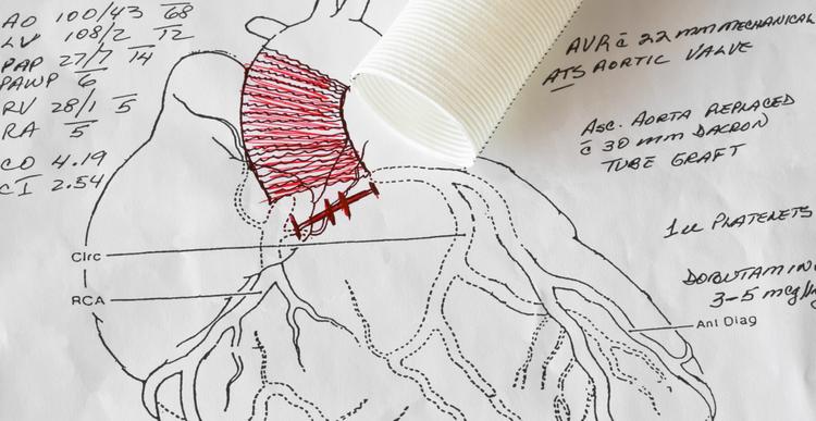 Achou aneurisma de uma porção da aorta? Não esqueça de avaliar o resto do vaso!