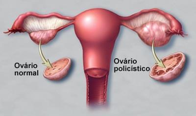 Síndrome dos ovários policístico: fisiopatologia