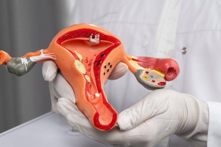Endometrioma