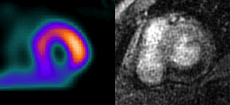É possível quantificar a isquemia miocárdica na ressonância de estresse?