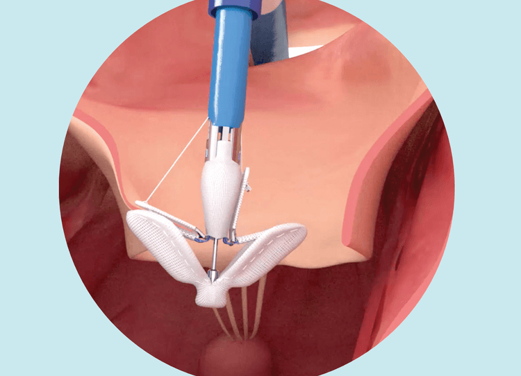 Mais um tratamento promissor para regurgitação tricúspide