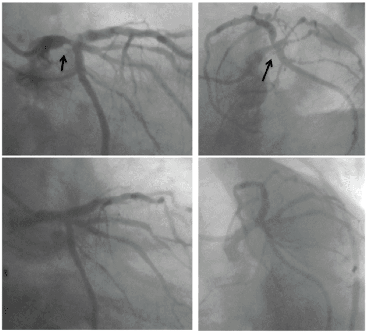 Aspectos práticos da angioplastia do tronco da coronária esquerda não protegido