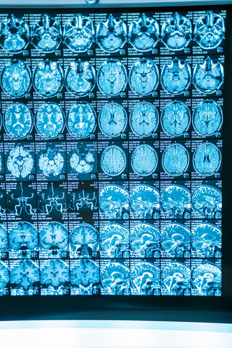 Placas carotídeas não-estenosantes podem causar AVC?