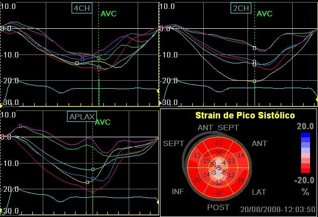 Strain miocárdico: 5 dicas que você precisa saber