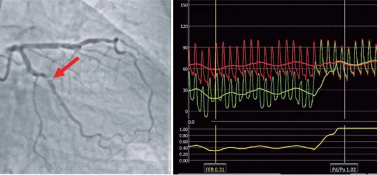 Como Angioplastia Guiada Fisiologicamente tem Revolucionado a Intervenção Coronária
