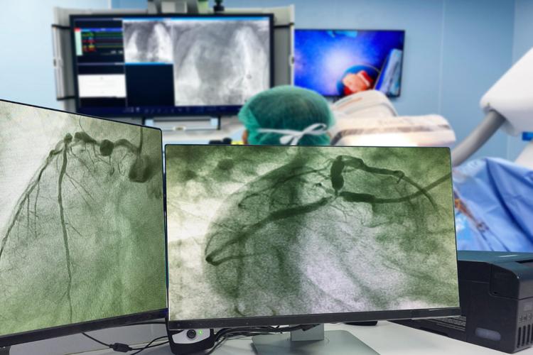 ISCHEMIA: Revascularização miocárdica melhora a qualidade de vida?