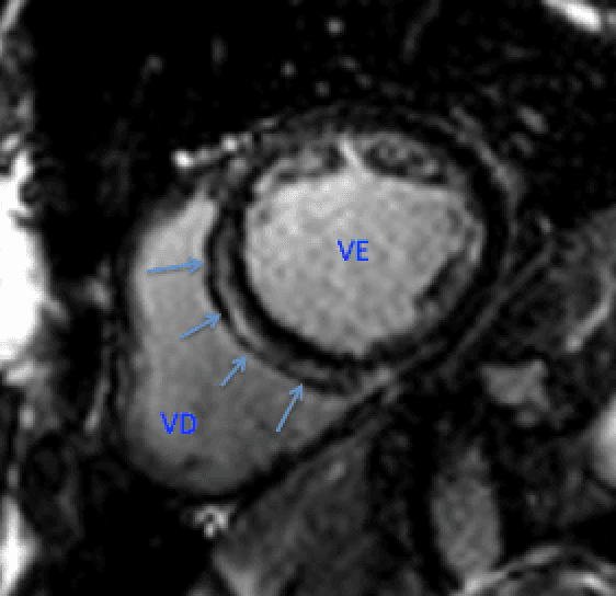 Como a Ressonância Cardíaca pode ajudar na estratificação de risco arrítmico em pacientes com Miocardiopatia Dilatada não isquêmica?