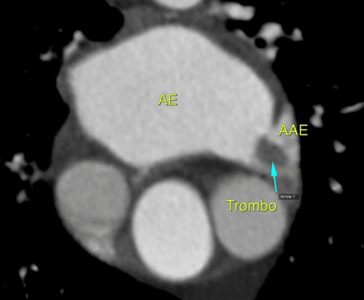Fechamento percutâneo do apêndice atrial esquerdo ou NOAC para pacientes com FA e alto risco de sangramento?