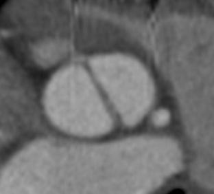 É seguro realizar TAVI em pacientes com valva aórtica bicúspide?