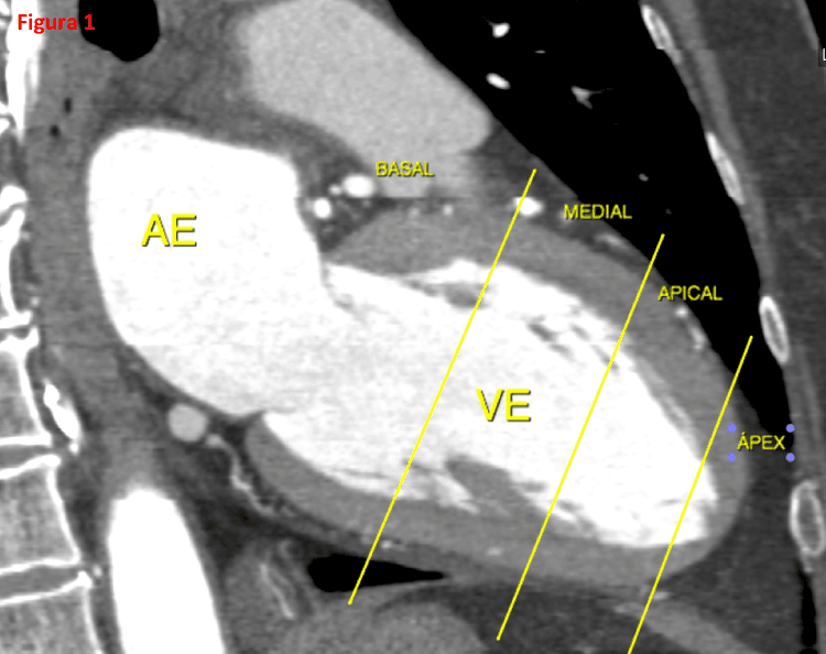 Por que os métodos de imagem dividem o coração em 17 segmentos?