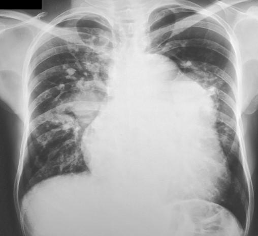 Qual a cardiopatia congênita desta paciente?