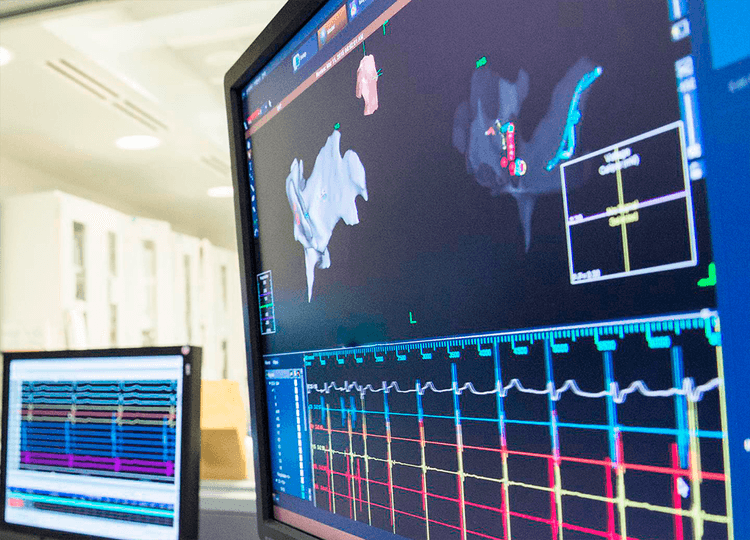O que você precisa saber sobre complicações da ablação de FA