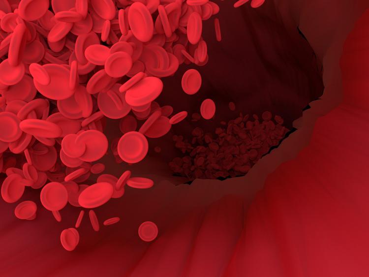 O que você precisa saber sobre trombose de valva aórtica?