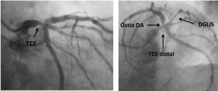 Abordagem Prática na Doença de Tronco da Coronária Esquerda
