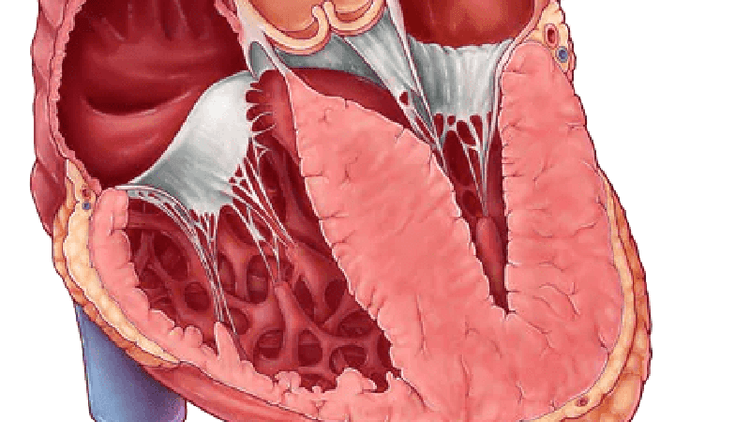 O Mavacanteno vai aposentar a Terapia para Redução de Septo na Miocardiopatia Hipertrófica?