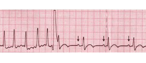 Manter o ritmo sinusal tem benefícios adicionais na fibrilação atrial!