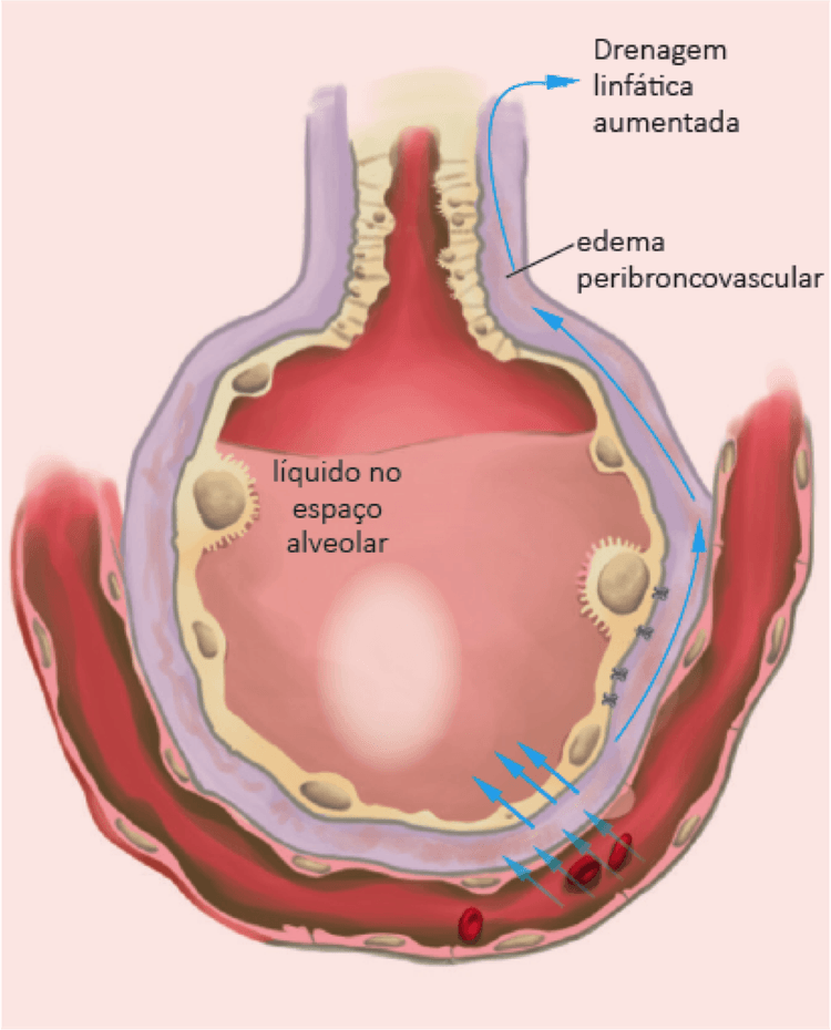 Pode haver edema agudo de pulmão sem o paciente estertorar até ápice?