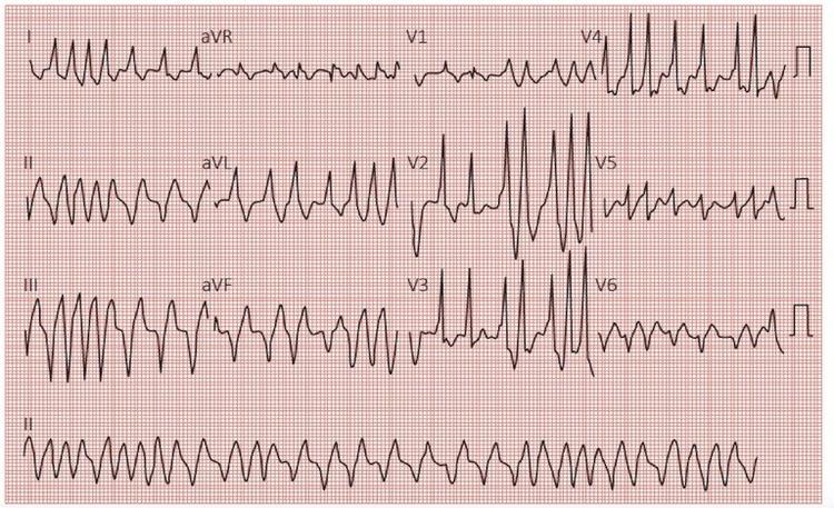 Quais as Novidades da Diretriz de Taquicardia Supraventricular? – Parte 2