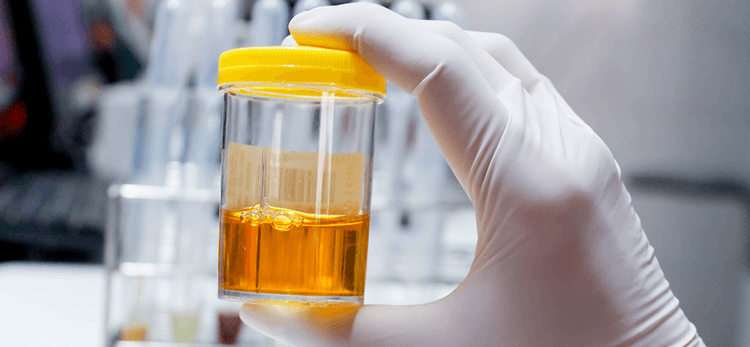 Peça Albuminúria do seu paciente, antes que seja tarde demais!