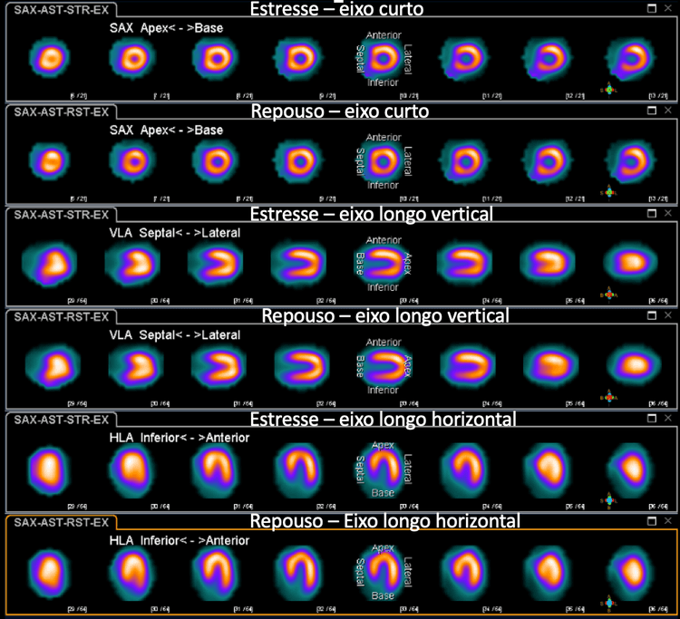 Você já ouviu falar em MINOCA. Mas, e em INOCA?
