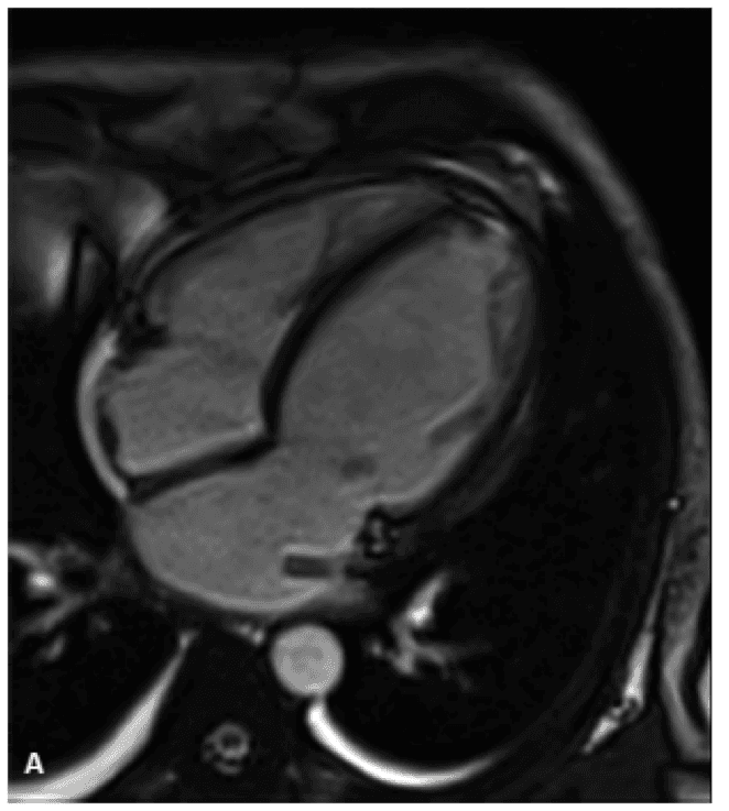 Hemocromatose cardíaca: como detectar na prática?