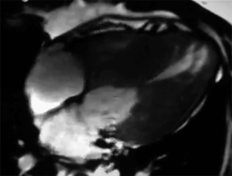 EXPLORER-HCM: mavacamten para pacientes com CMH obstrutiva!