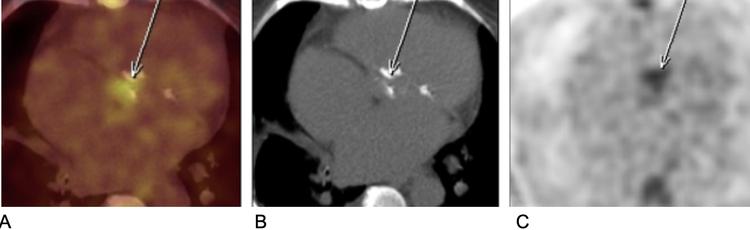 PET/CT para avaliar Endocardite: 10 tópicos que você não pode deixar de saber!