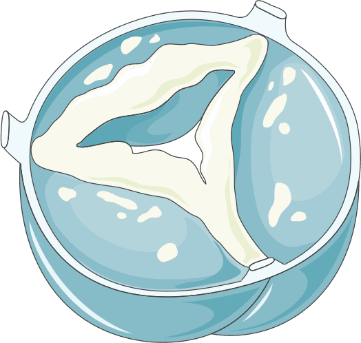 Lidando com os desafios da estenose aórtica moderada