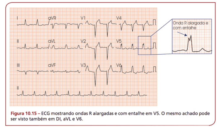 Existe Miocardiopatia Induzida pelo Bloqueio de Ramo Esquerdo?