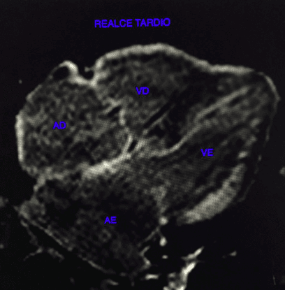Viabilidade miocárdica: como avaliar de forma correta pela ressonância magnética cardíaca?