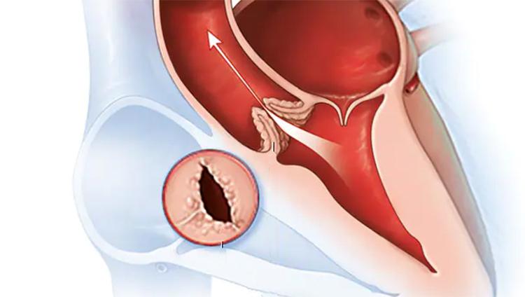 Saiba aqui tudo sobre Valva Aórtica Bicúspide